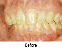 Porcealin Veneer Before Picture